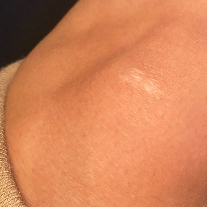 The fact I have one on my left knee lmao😂 https://t.co/uAQTBT3E7O