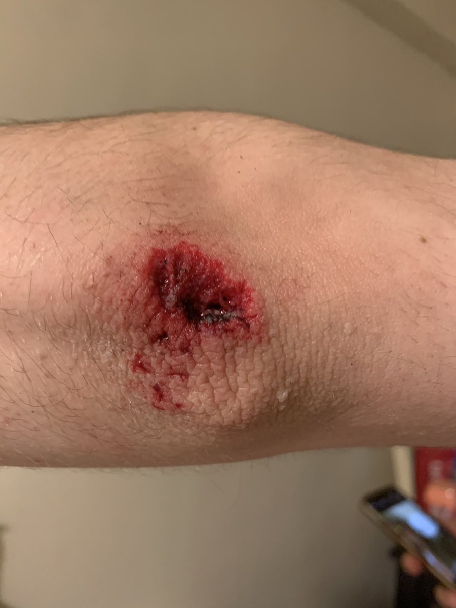 Here’s my elbow after getting thrown to the ground by a police officer i bumped into while filming.