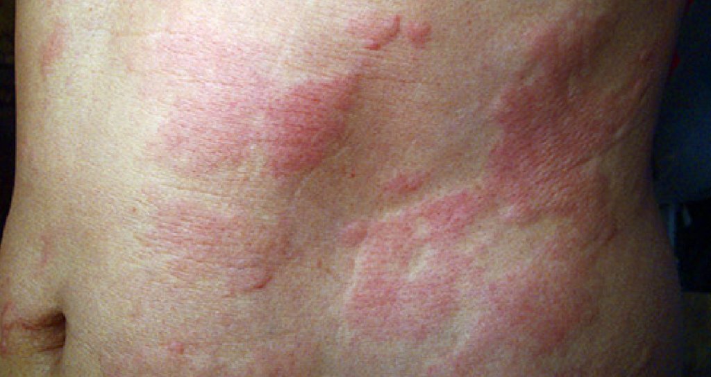 MD on Twitter "Hives can be a sign of an allergic reaction, but
