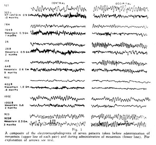 ClinicalNeuroph's tweet photo. [History of EEG-based biomarker] Little and MaAvoy (1949) assessed the efficacy of an antiepileptic drug, using EEG measures before and after the drug injection.

https://t.co/2dR1PU4ZUU 
#EEG #Epilepsy #ClinicalNeuroph https://t.co/zPQIVDugpe