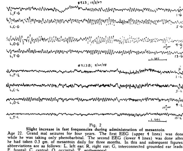 ClinicalNeuroph's tweet photo. [History of EEG-based biomarker] Little and MaAvoy (1949) assessed the efficacy of an antiepileptic drug, using EEG measures before and after the drug injection.

https://t.co/2dR1PU4ZUU 
#EEG #Epilepsy #ClinicalNeuroph https://t.co/zPQIVDugpe