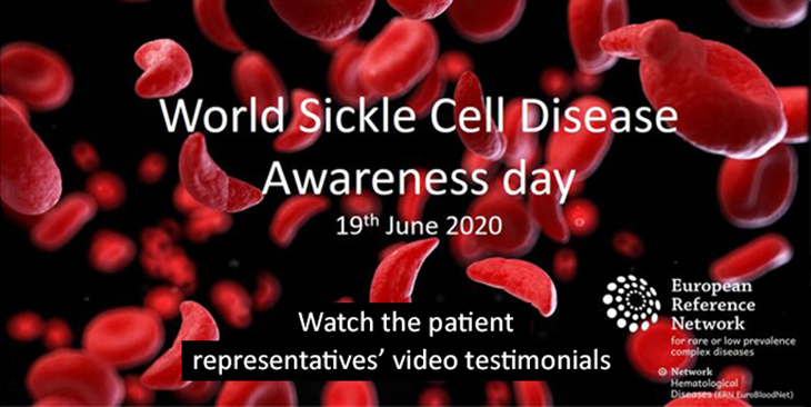 eurordis's tweet photo. For WSCD2020, ERN-EuroBloodNet collected SCD patient representatives’ video testimonials on the importance of having a common unique patients’ voice in Europe and engaging patients thoughts in research: https://t.co/nrjXUp0LUP #WorldSickleCellDay #WSCD20 #sicklecell #scdglobal https://t.co/292RURqJVo