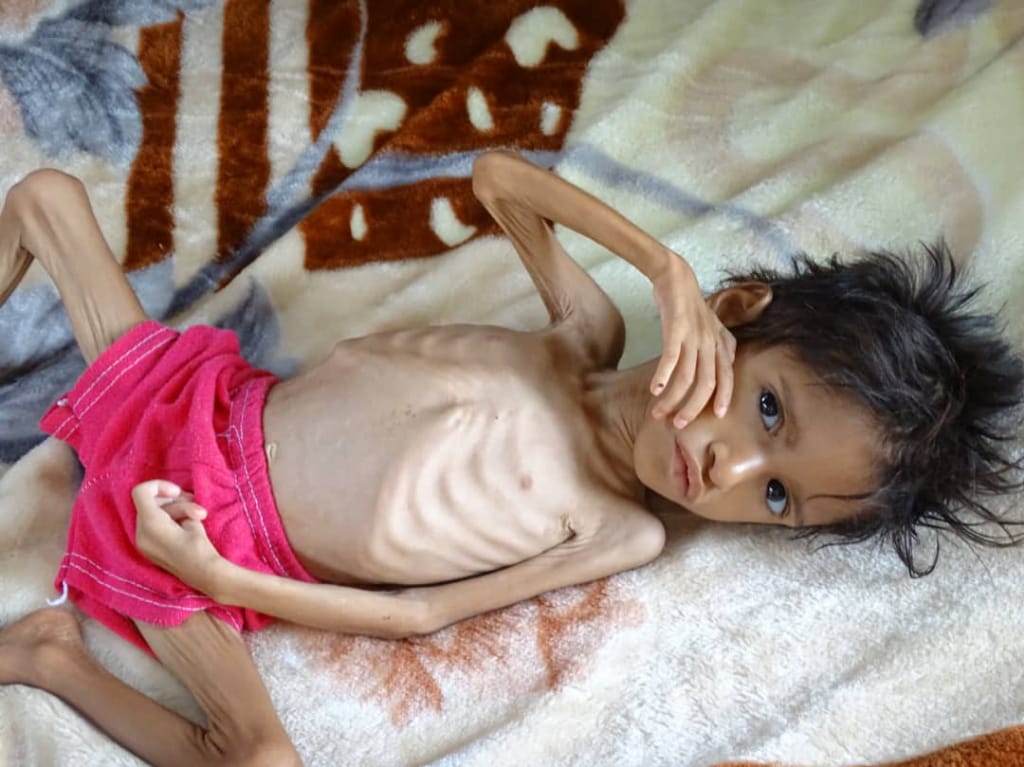 This is Salwa Adabi, five years old. She suffers from acute malnutrition, and she is from a poor, displaced family who lives in Bani Al-Adhaby area, Abas- Hajjah Governorate. #Yemen.
Her father sold everything he had to treat her, but he could not save her from malnutrition.