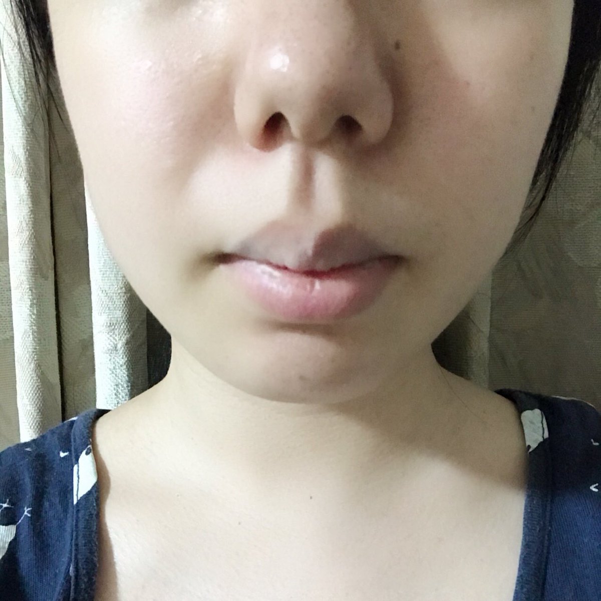 みぃる 歯列矯正 Mi Ruru Twitter みぃる 歯列矯正 Mi Ruru Twitter