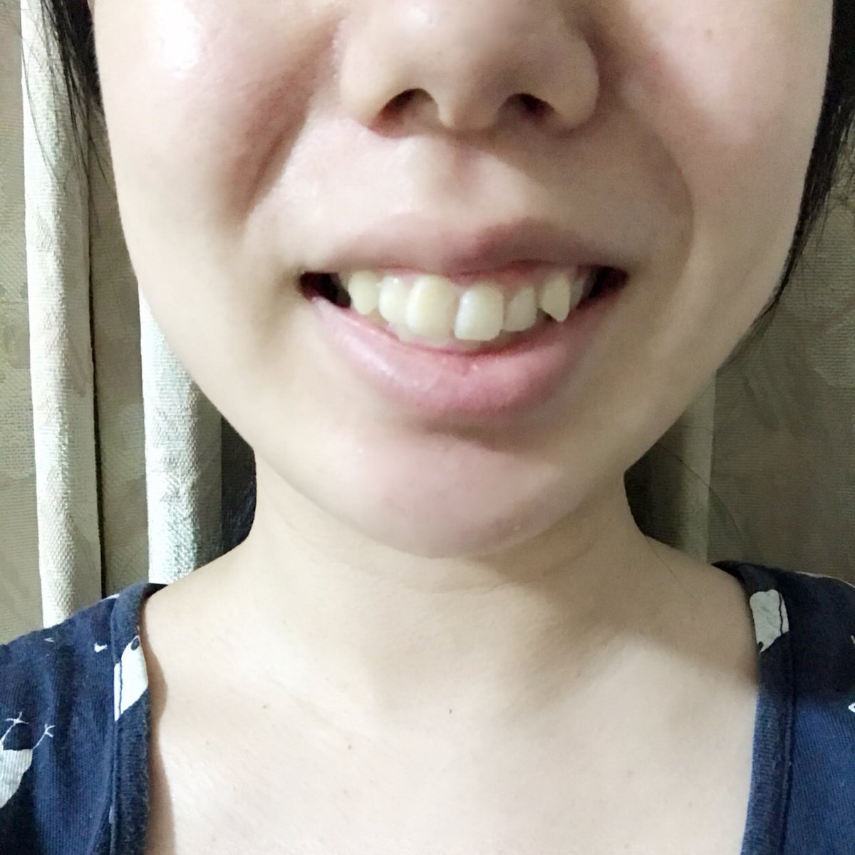 mi__ruru's tweet photo. 【矯正０日】
歯並びbefore写真
輪郭がおかしい
歯が右に傾いてる・出っ歯
下の歯はすきっ歯
ごぼ口 https://t.co/nQxjbc6u0c