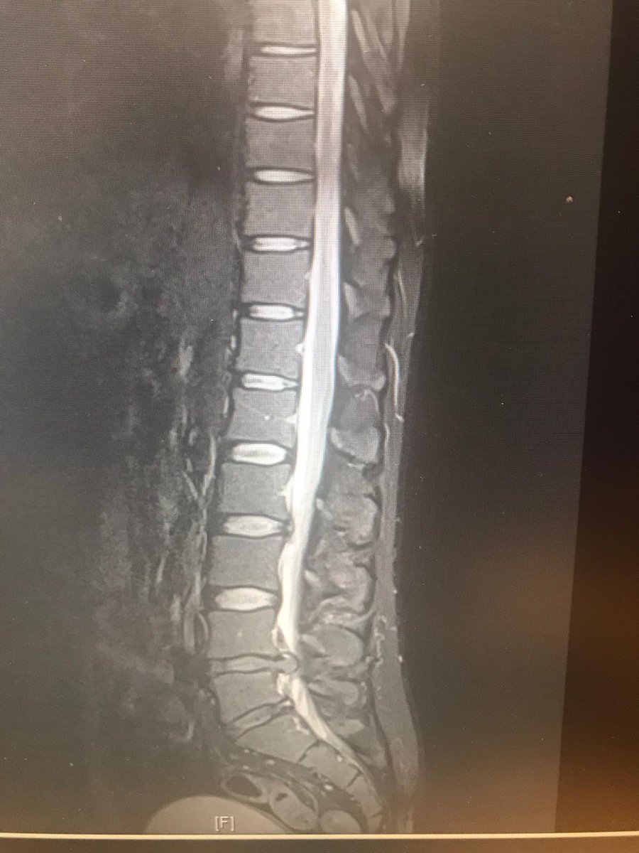 ABBIE_ACP's tweet photo. Male, 34, ongoing back pain “for years”, (we have all heard this line!). Presented to ED; worsening back pain. Upon asking specifically about #ErectileDysfunction, he disclosed! No other #RedFlags were identified. #CordCompression #DontForgetTheAwkardQuestion! #ACP #ED #Ortho https://t.co/L8MyZmzUPM