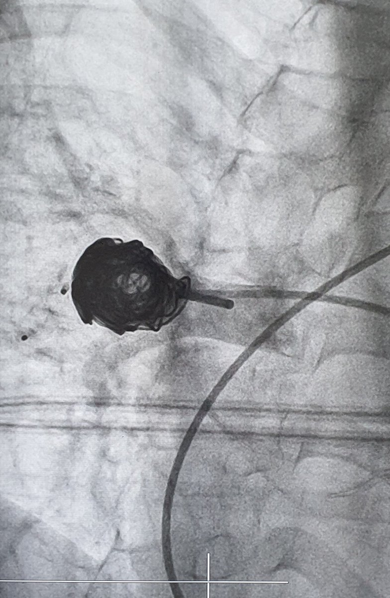 DrLe2287's tweet photo. Transjugular to embolize a giant ruptured aneurysm of pulmonary artery which caused severe hemoptysis in a child. #RubyCoils with maximum length (60cm) and undersized diameter are chosen to achieve good packing. https://t.co/JooipdB3oK