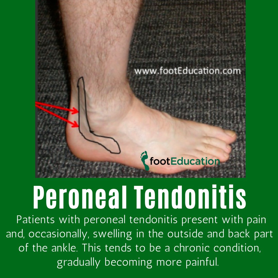 Peroneal tendonitis: buff.ly/37Ci8bG