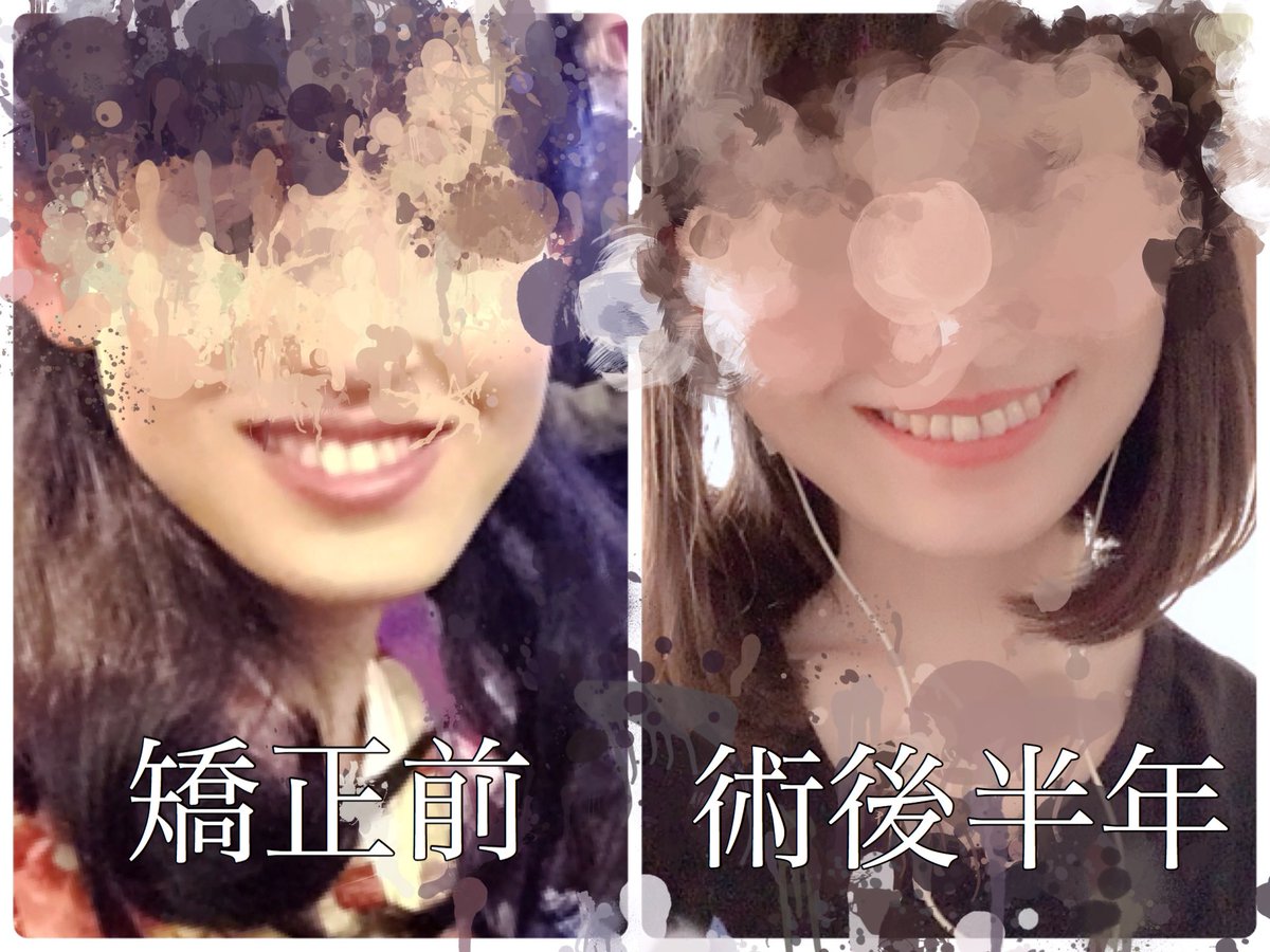 hottosandoicchi's tweet photo. 四角かった顎が丸くなってて嬉しいー
オトガイ形成は私には必須だった https://t.co/DoHftjdjla