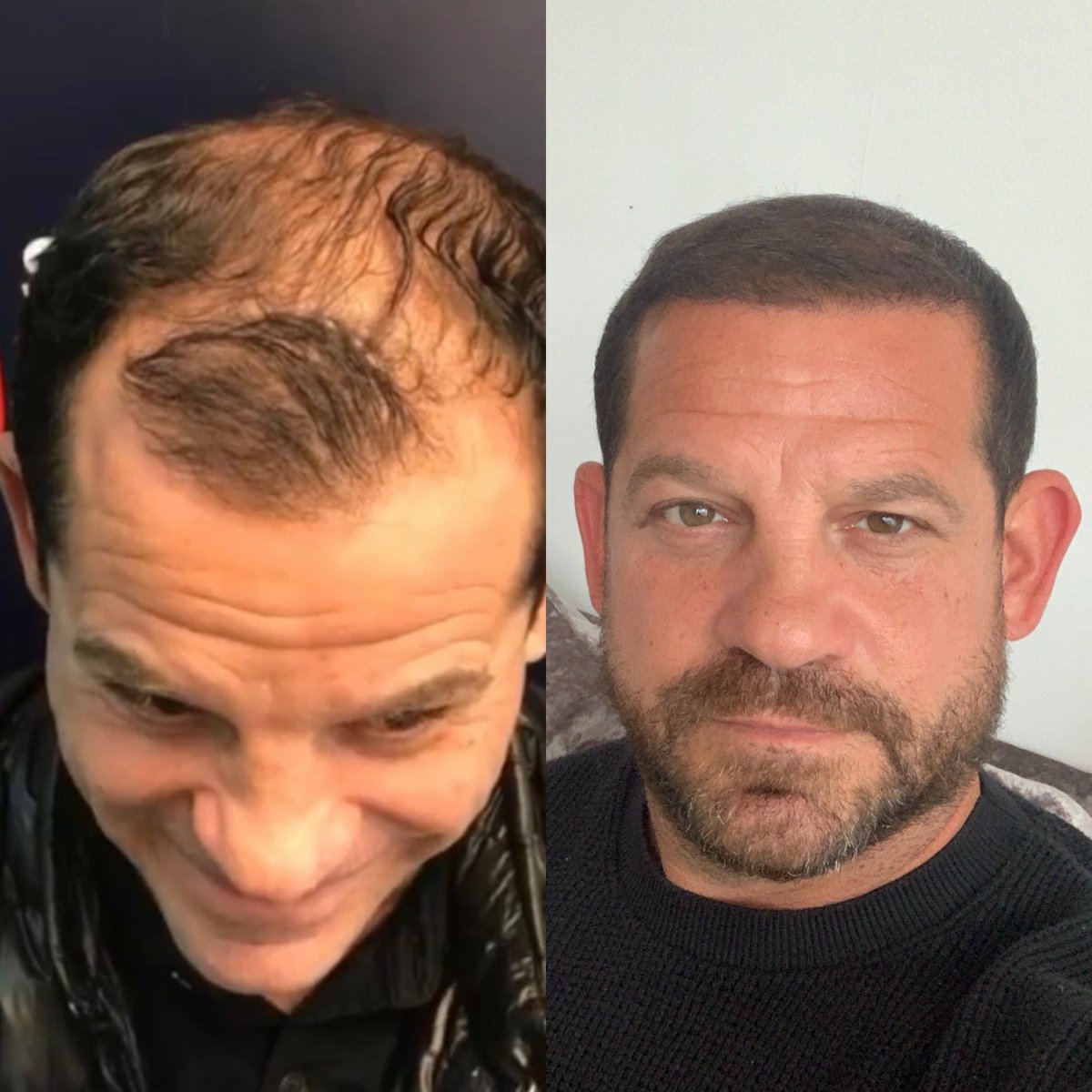 Here’s the amazing results of my hair transplant after 5 months, can’t thank the @Brithairclinic enough, I’m your thinking about getting your hair done, DM me for more info 👍🏻👊🏼