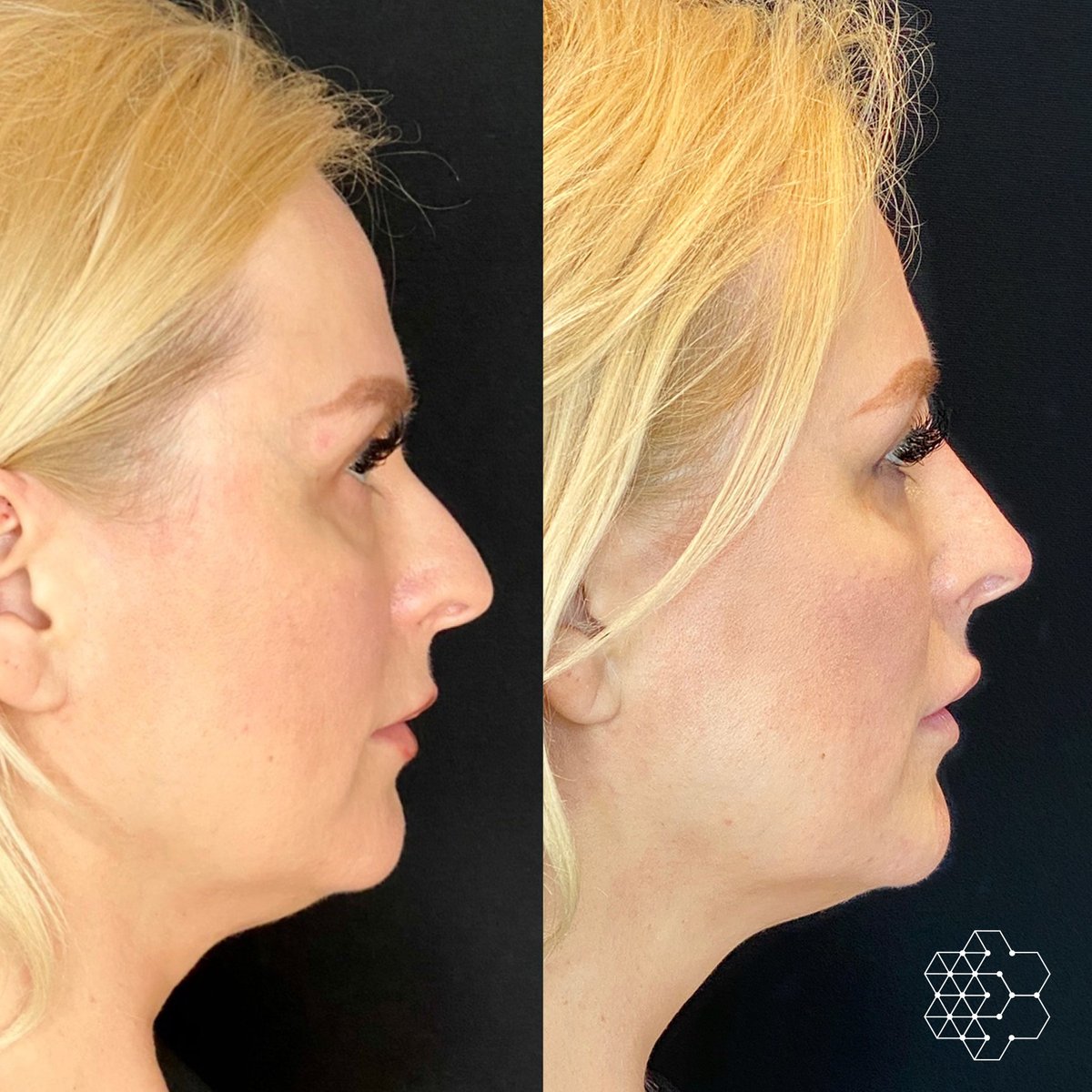 drpavlou's tweet photo. Changing our lovely patients’ profile with dermal fillers. Even though we added filler, the nose actually appears smaller.

https://t.co/qBzgCDuk80

#nosetechnique #nonsurgicalnose #nose #nosejob #nonsurgicalnosejob #beforeandafter #drpavlou #nosefiller #skintechnique https://t.co/b93oRzlQw1