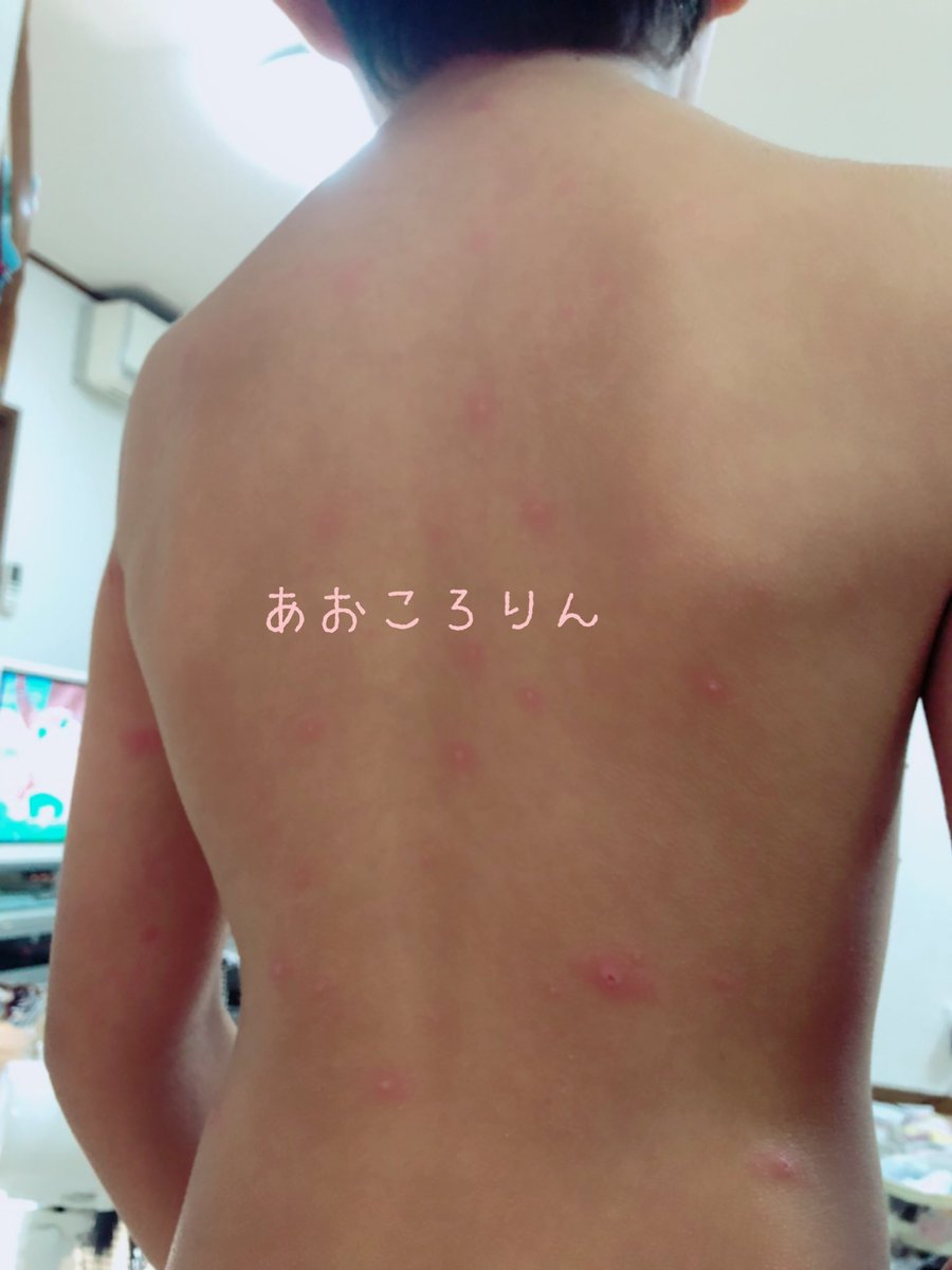 Aocororin 観覧注意 息子の背中 だいぶ広がっていて痒そう 顔もポツポツと 娘も今まで水疱瘡になったことないので うつったら大変だな 朝から気持ち悪い写真でごめんなさい 水ぼうそう 10歳