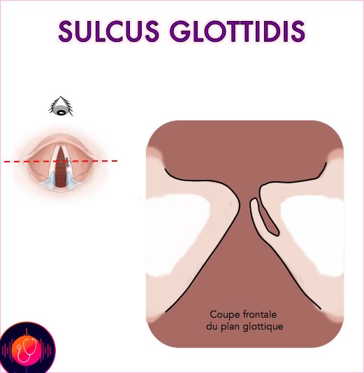 docteurdelavoix's tweet photo. #sulcus #cordesvocales #phonochirurgie #orthophonie #dysphonie https://t.co/B5hikOrkGu