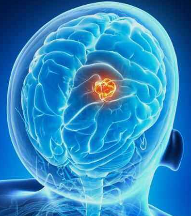 ctnsd_editor's tweet photo. #CTNSD [Study Protocol] Use of low-dose dexmedetomidine in general anesthesia improves postoperative recovery of patients with supratentorial tumors: study protocol for a randomized controlled trial
#supratentorialtumor #anesthesia #neurosurgery #recovery

https://t.co/N7qdfOs0oO https://t.co/eYlbyNICNK