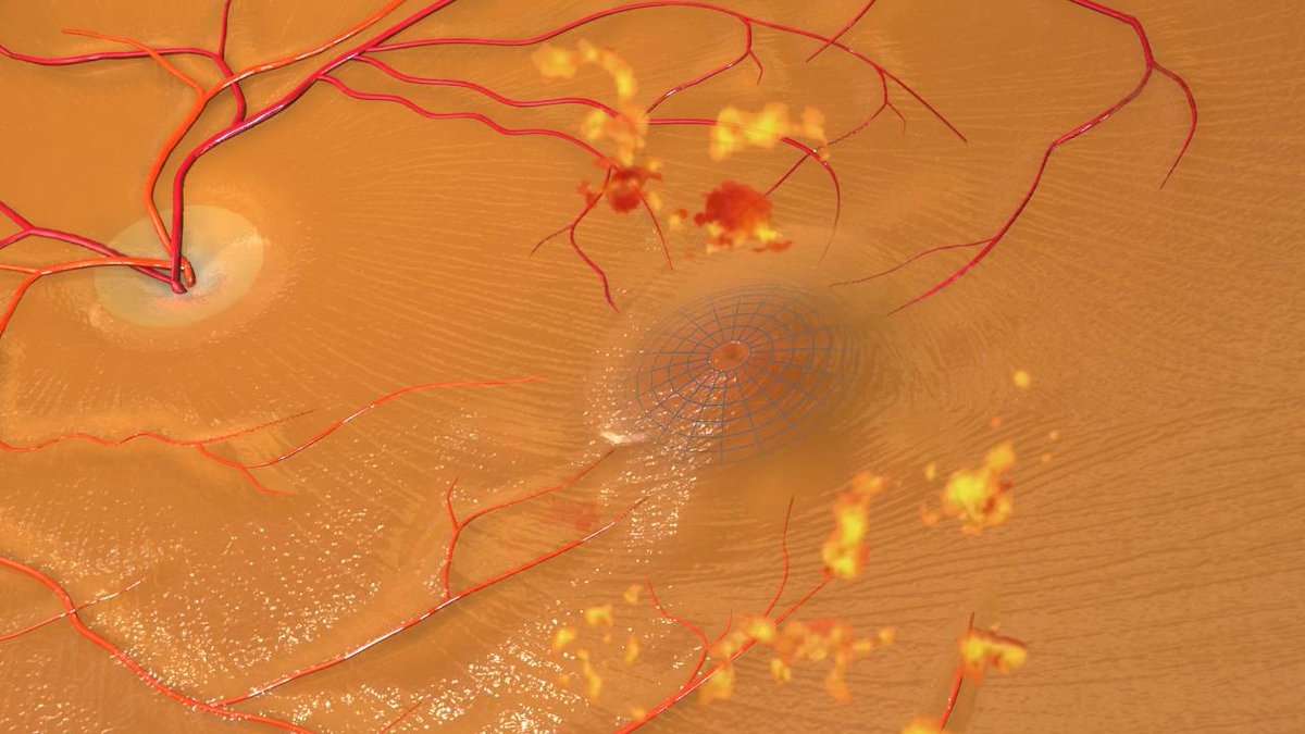 sight_nu's tweet image. ow.ly/5g6W102hqiL ow.ly/CYFE102hsS8 Type 2 diabetes: Three consequential symptoms in the eyes caused by