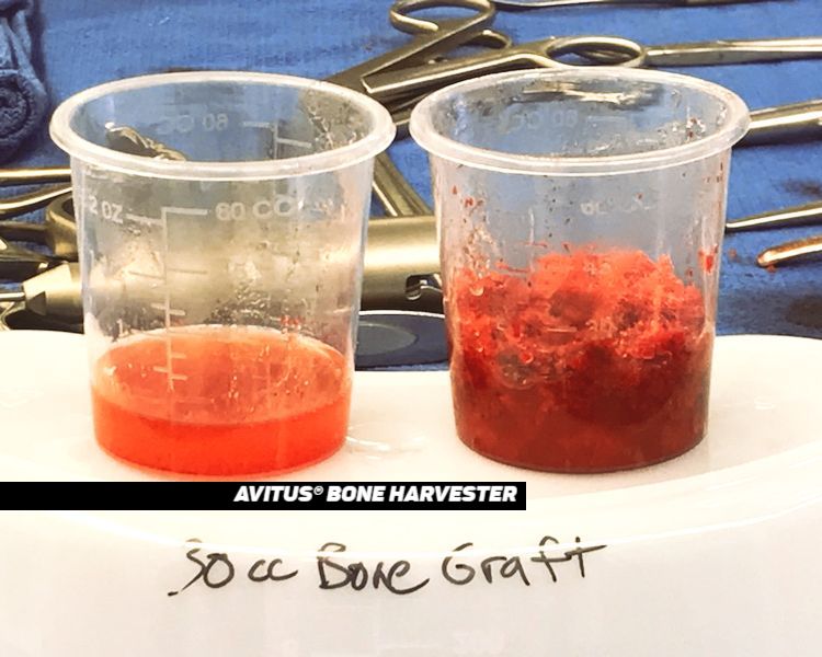 AvitusOrtho's tweet image. Make sure your next bone harvest is a complete one. Bone &amp;amp; marrow with the Avitus® Bone Harvester. ⠀
⠀
#bonegraft #autograft #proximaltibia #avitus #avitusorthopaedics #boneandmarrow