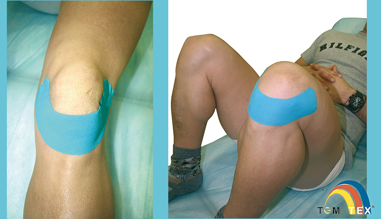 Temtex_Es's tweet photo. Presentamos una técnica de Vendaje Neuromuscular indicada para los casos de Osgood Schlater o de Patela Baja.
Esta aplicación, forma parte del libro - manual sobre Kinesiotaping "80 aplicaciones prácticas" de Txema Aguirre y María Achalandabaso.
 
➡️https://t.co/53vvVqU7Ay https://t.co/lJpJdDpIEb