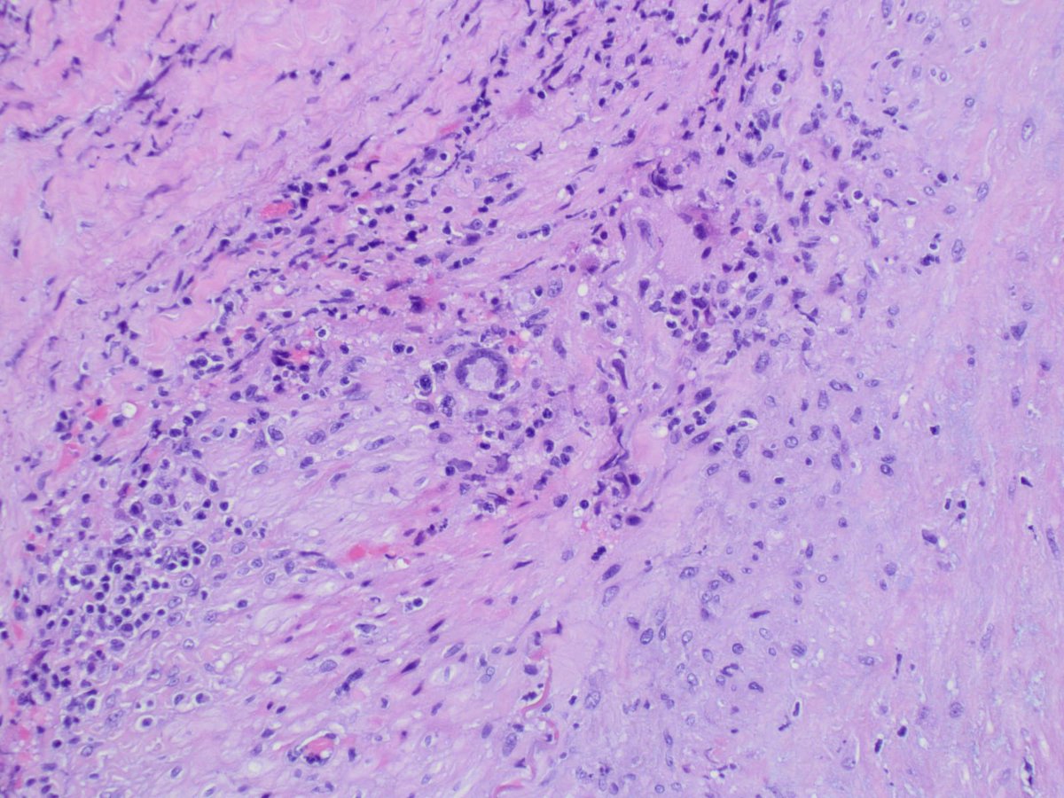 Reumatologia Sant Pau-Dos de Maig (@reuma_santpau) on Twitter photo Quan l'anatomia patológica ens explica que està passant: Vasculitis de cel.lules gegants.
Veieu l’infiltrat inflamatori vascular.
Imatges de <a href="/APsantpau/">Anatomia Patològica Sant Pau</a> <a href="/pmoyaal/">Patricia Moya</a> <a href="/HospitalSantPau/">Sant Pau - Campus Salut Barcelona</a>. Quan l'anatomia patológica ens explica que està passant: Vasculitis de cel.lules gegants.
Veieu l’infiltrat inflamatori vascular.
Imatges de <a href="/APsantpau/">Anatomia Patològica Sant Pau</a> <a href="/pmoyaal/">Patricia Moya</a> <a href="/HospitalSantPau/">Sant Pau - Campus Salut Barcelona</a>.