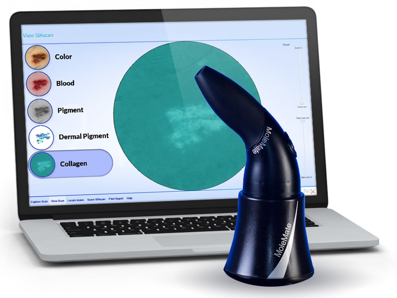 MedXHealthCorp's tweet photo. For the first time, physicians can more accurately evaluate suspicious #moles and #lesions in a non-invasive, pain-free way. Know more about the benefits of our technology. https://t.co/v5xHUaOmfS #Cancer #SkinCancer #Melanoma https://t.co/K10ZQzDvH6