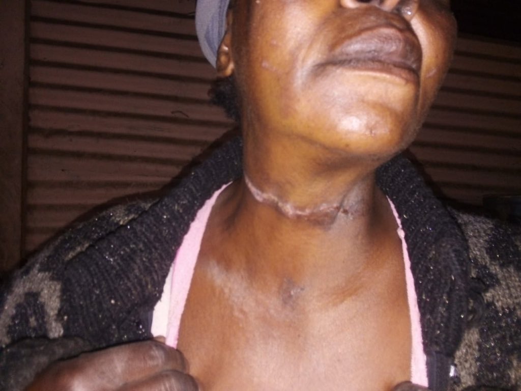 mwelimasilela's tweet photo. 50 year-old Martha Mdluli from Waterval Boven Mpumalanga left with permanent scars on her body after surviving four incidents of abuse allegedly in the hands of her partner. She says police have failed her. For more watch @Newzroom405 https://t.co/EXquCbymlm