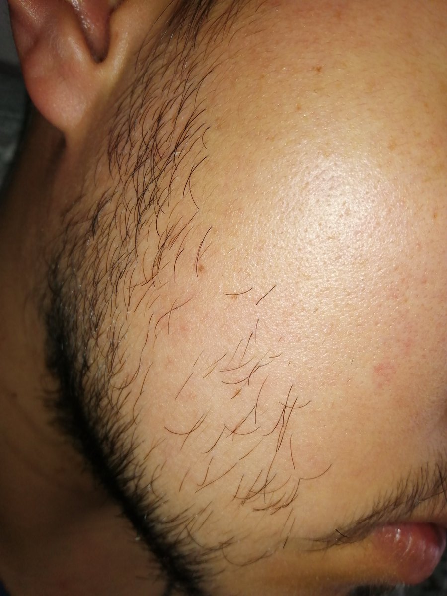 Diario_Minox_'s tweet photo. Y así va creciendo poco a poco los vellos en su desarrollo de crecimiento.
Día 23 de tratamiento 🧔🏻 https://t.co/L3WOjP1JGN