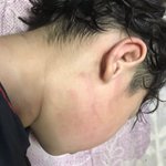これはひどい!放課後デイサービスでの職員による体罰の後が痛々しい!