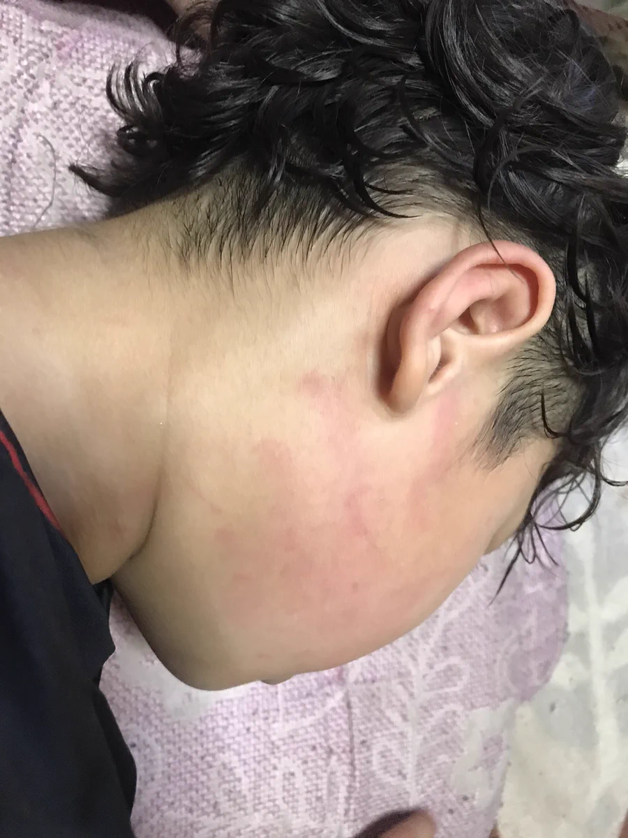 これはひどい！放課後デイサービスでの職員による体罰の後が痛々しい！