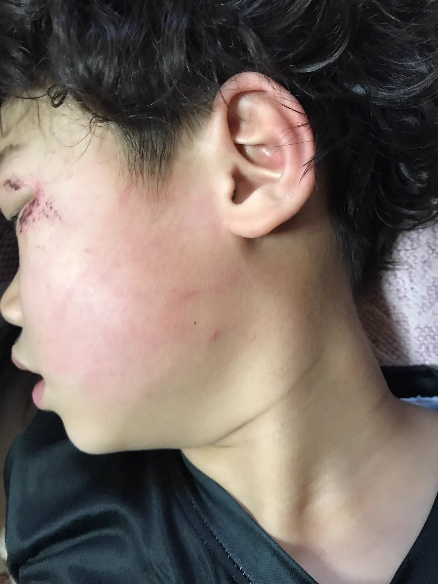 これはひどい！放課後デイサービスでの職員による体罰の後が痛々しい！