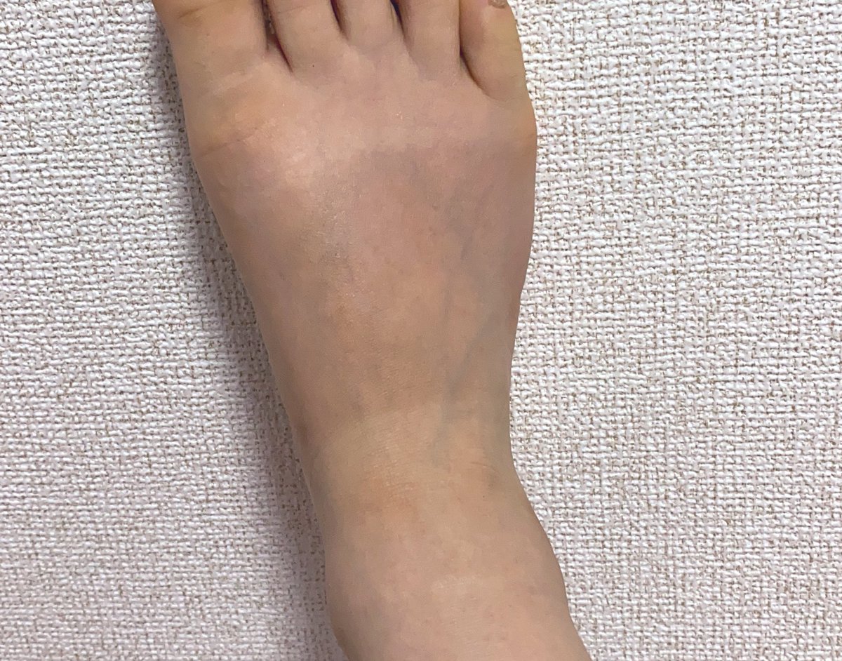 Hitomi 足の甲 サンダルの形にくっきり日焼けしてることに気づいた 笑 日焼け止め甘かったか まぁいいか足だし すごい浮腫んでる