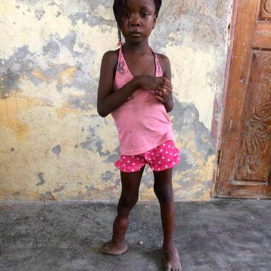 Djounica was born with #AmnioticBandSyndrome but thanks to our partnership w @foryouhaiti she's well on the mend! #Haiti