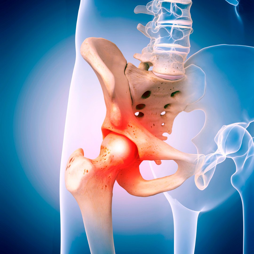 If you’ve been living with hip pain stemming from arthritis or conditions like hip dysplasia, hip resurfacing can be a good option. In this procedure, the surgeon will replace the damaged surface of the hip joint with a smooth covering that helps a patient live pain-free.