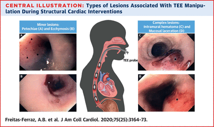 ? #JADEL 
<a href="/ASE360/">American Society of Echocardiography</a> 

Am I the only one that finds this just a wee bit disturbing?

Post-TEE EGD found a new injury in 86% (43/50pts).
Complex lesions in 40% (20/50pts).