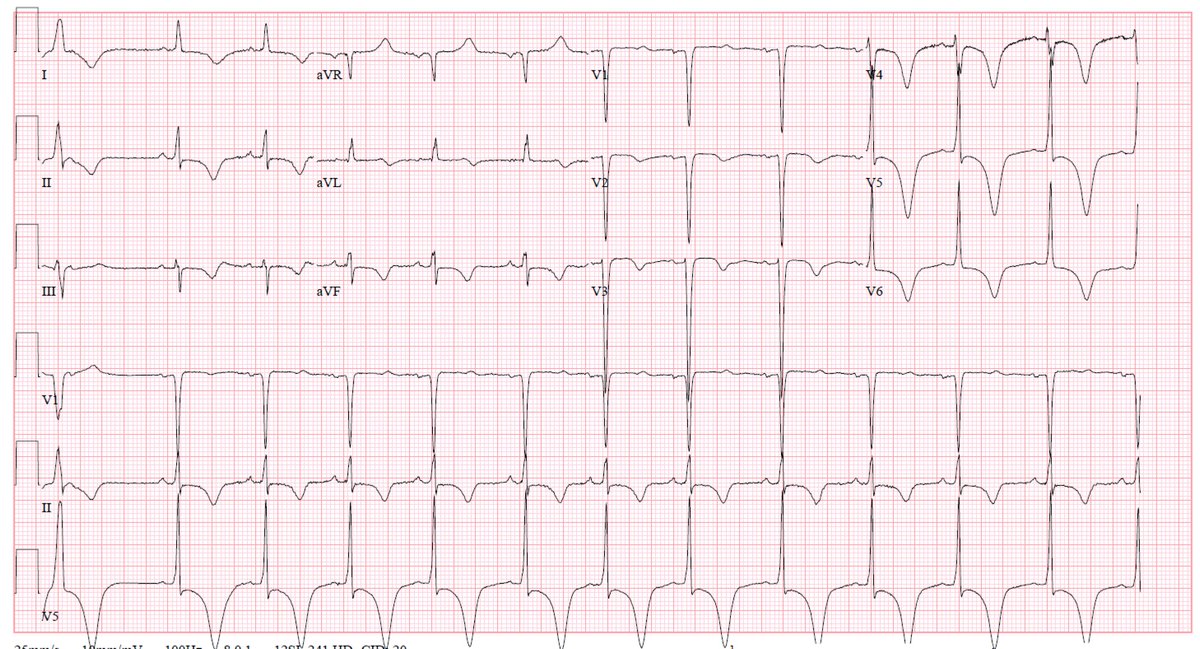 More T wave inversion with QTc prolongation. Older female patient with CP/SOB. Electrolytes normal. No neuro issues. See thread for ECGs. Thoughts? Will post answer tonight.  #ECG  #MedEd  #MedStudentTwitter  @EM_RESUS  @smithECGBlog