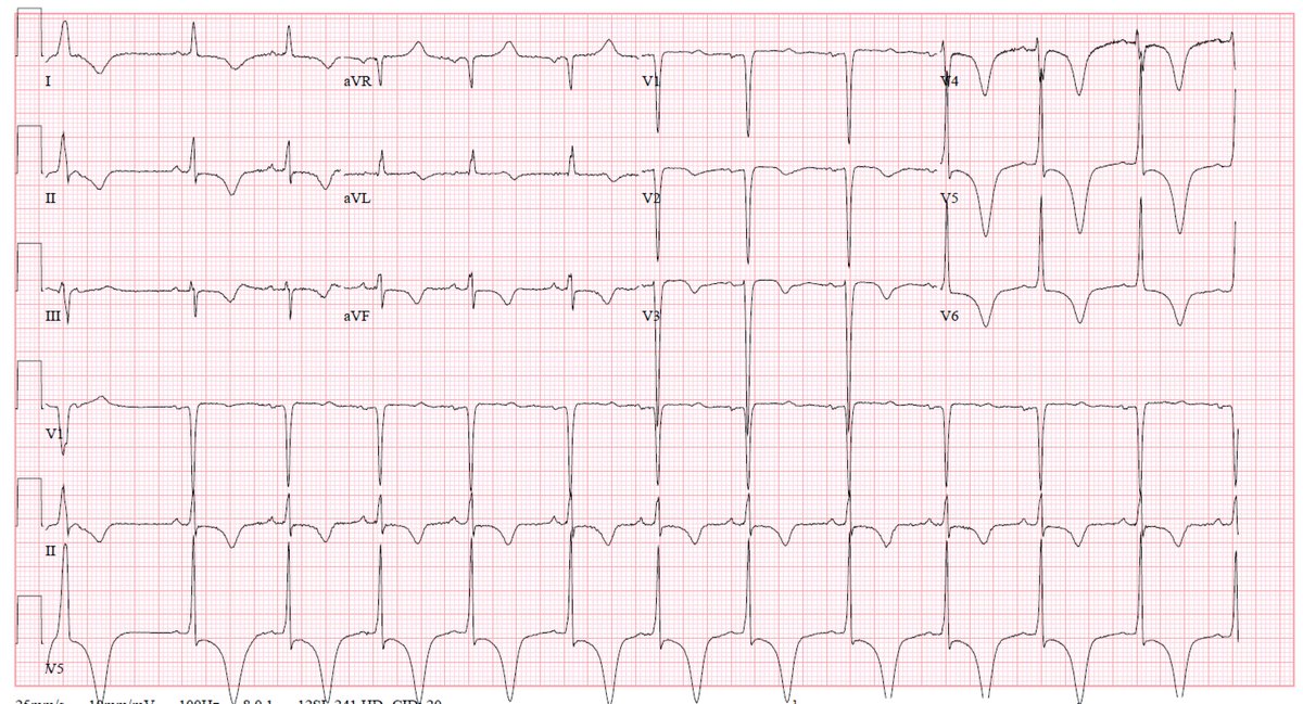 More T wave inversion with QTc prolongation. Older female patient with CP/SOB. Electrolytes normal. No neuro issues. See thread for ECGs. Thoughts? Will post answer tonight.  #ECG  #MedEd  #MedStudentTwitter  @EM_RESUS  @smithECGBlog