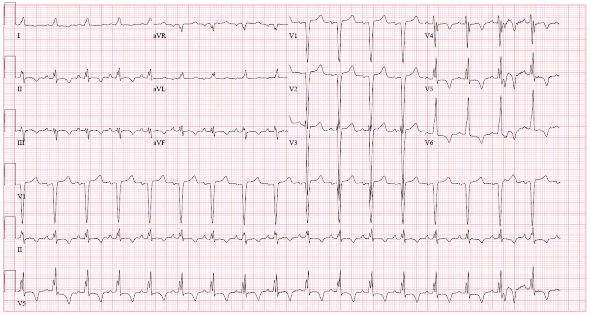 Initial Troponin I positive at 2.45. Initial ECG obtained in ED