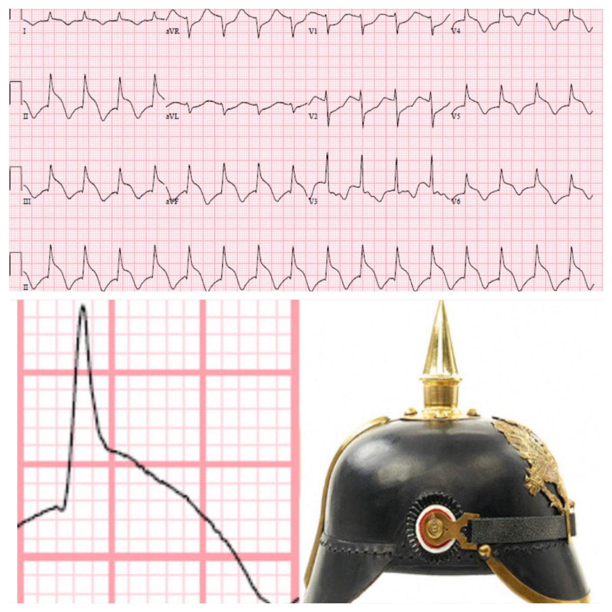 Another Pickelhaube sign but not on #echofirst but on #EKG spiked-helmet sign (SHS): elevation of isoelectric line precedes QRS, followed by a sharp R wave & then convex ST-segment elevation mimics acute MI Adrenergic excess/prolonged repolarization bit.ly/3hVdkmw