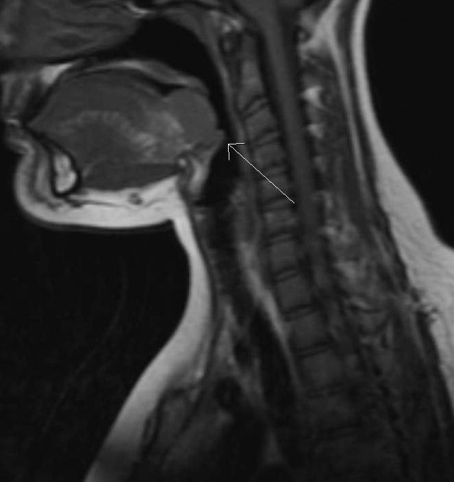 Lingual thyroid is the most frequent ectopic location of thyroid gland  due aberrant embryogenesis during the descent of thyroid gland to the neck.↙️👨🏻‍⚕️👩🏻‍⚕️📚

Prevalence:➡️ 1 in 100000 to 1 in 300000
Lingual thyroid is 4-7 times more common in females.

#SoMe4IQLatAm #SoMe4Surgery