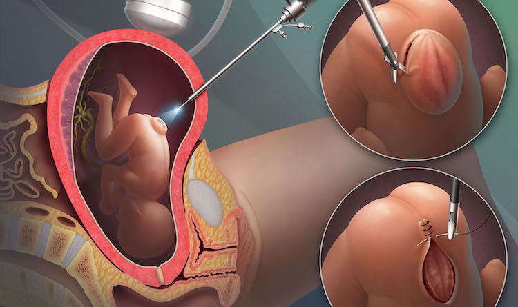 Study in #UOGJournal finds novel minimally #invasive approach of #fetoscopic repair of open neural tube defects,  leads to fewer #Csection &amp; #preterm #delivery with similar cost of care, compared to the #hysterectomy approach: bit.ly/37Xod2o <a href="/masancor07/">Magda Sanz</a> <a href="/ISUOG/">ISUOG</a> #surgery