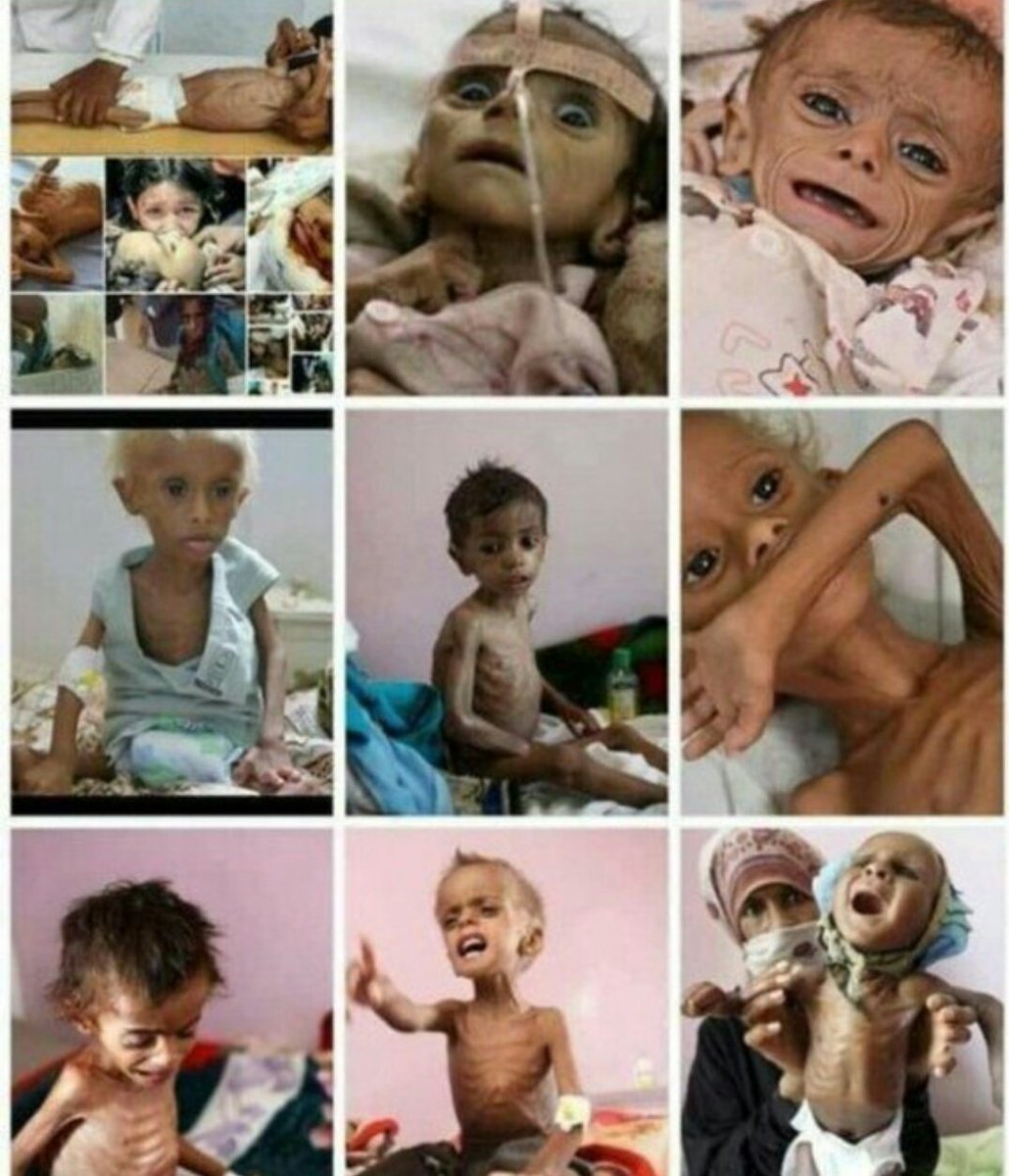 These pictures are only a drop in the ocean of the crisis Yemen has been and still going through. Yemen is the victim of inhuman acts that are going to lead to its extinction. We need to come together and raise our voices...it does make a change.
#YemenCantBreathe #FREEMENA