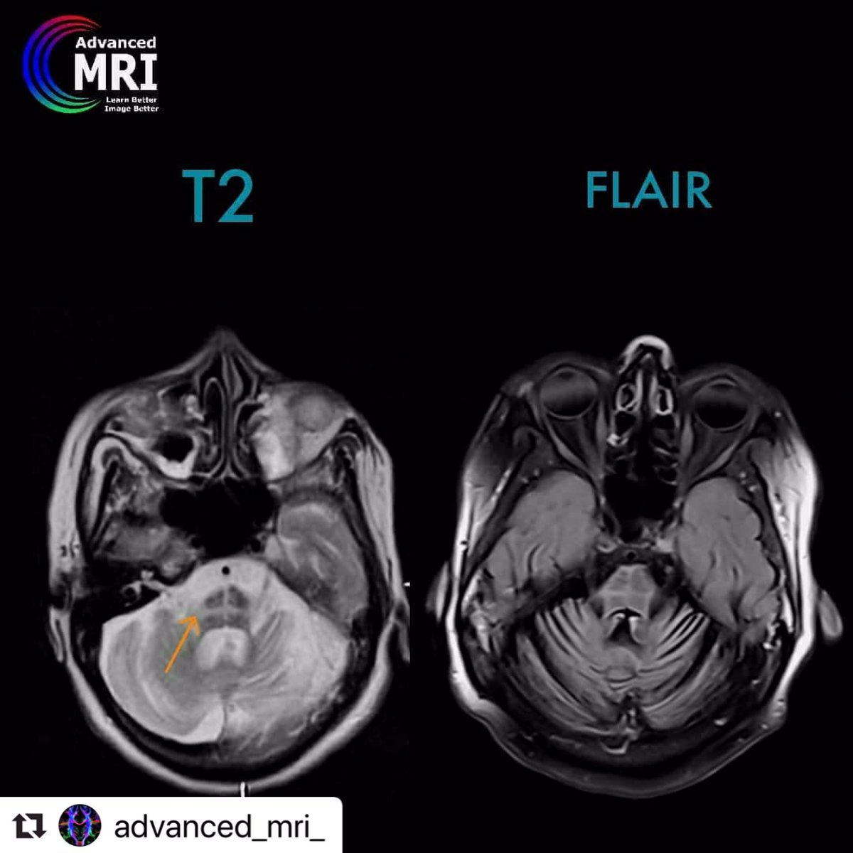 advanced_mri's tweet photo. Hot Cross Bun Sign
#mri #pathology #sign #advancedmri #advanced_mri https://t.co/8Ynq9ZOFVU