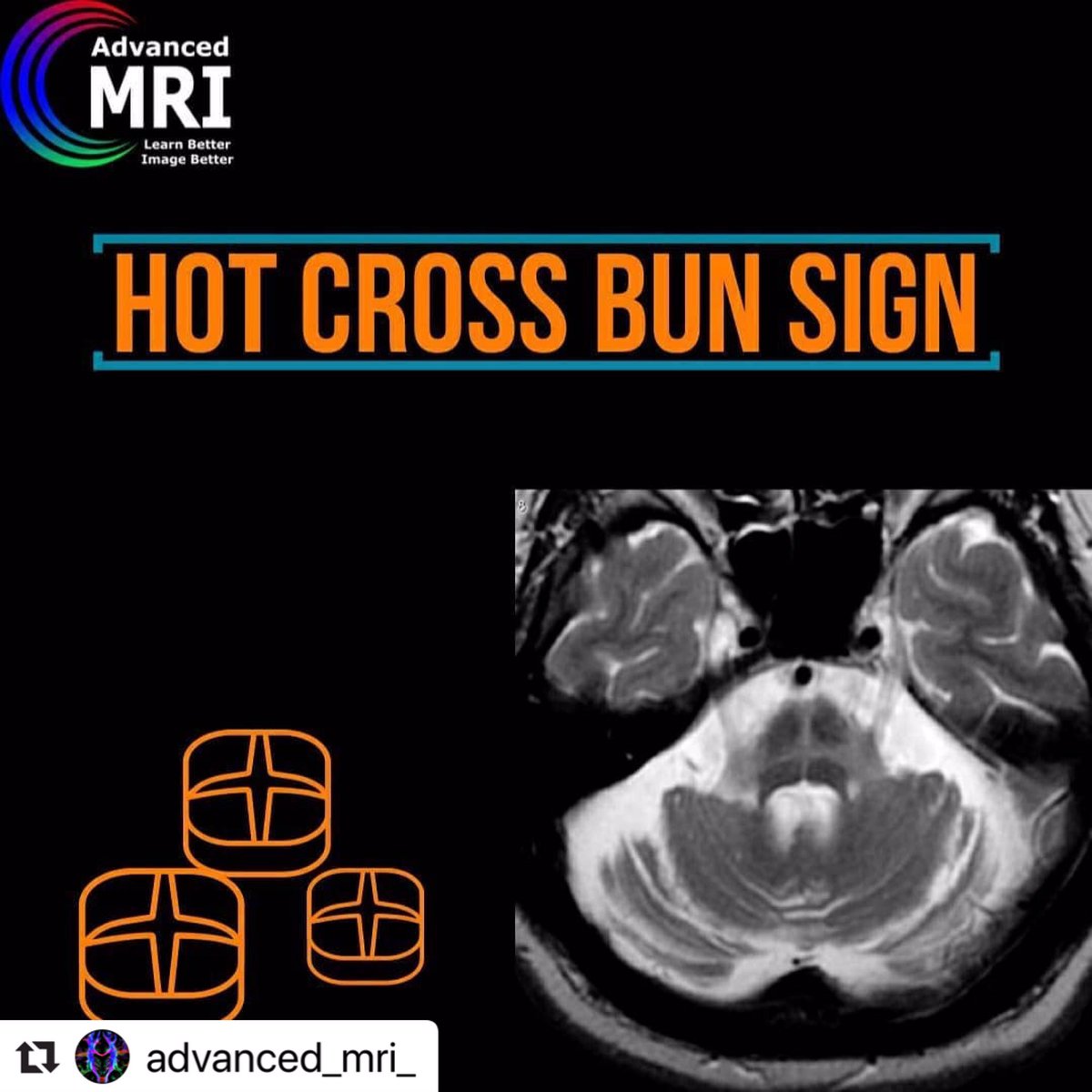 advanced_mri's tweet photo. Hot Cross Bun Sign
#mri #pathology #sign #advancedmri #advanced_mri https://t.co/8Ynq9ZOFVU