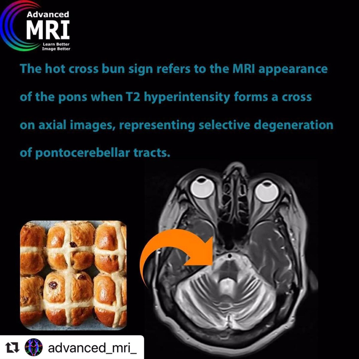 advanced_mri's tweet photo. Hot Cross Bun Sign
#mri #pathology #sign #advancedmri #advanced_mri https://t.co/8Ynq9ZOFVU