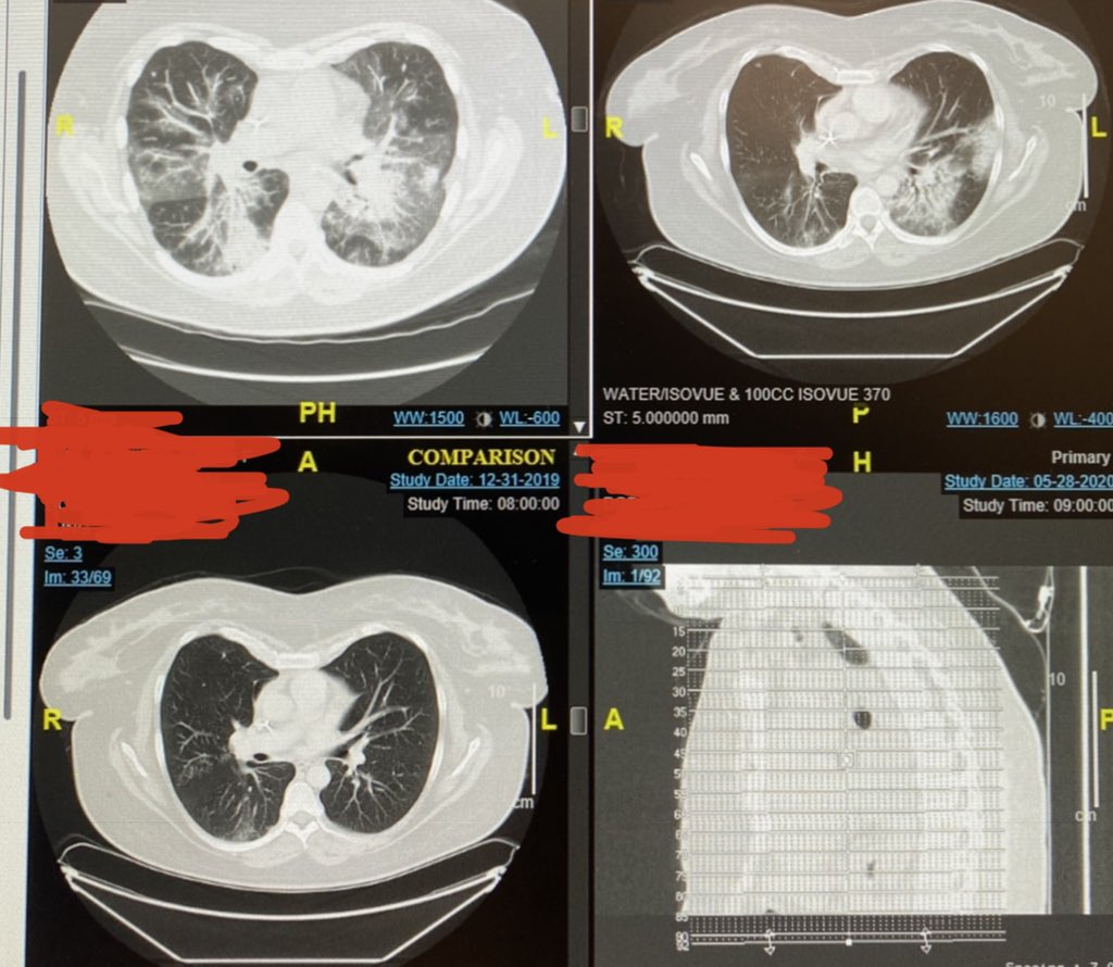 DrShamwell's tweet photo. This is what SARS-CoV-2 has done to my patients lungs. I’m tired. I don't want to be nice to people who refuse to do the right thing.
Don't be selfish.
WEAR A MASK! https://t.co/G80WDVkQzN