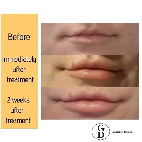 DentalGrandis's tweet image. This patient wanted a more refined look for her lips. Dr Gretchen used 1ml of premium dermal filler to achieve a desired fuller look.
1ml of premium dermal just $300.
Contact our friendly team on 6404 2899 to book your consultation today.
#grandisdental #refinedlook