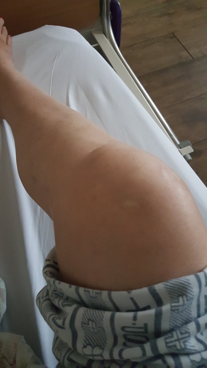 무릎이 너무 아파서 참다 참다 병원 왔더니 무릎 연골이 개절단 났다네ㅠ
찢어진데 또 찢어지고 그옆에 또 찢어져서 너덜너덜 개지저분 하다네ㅠㅠ
당장 수술 해야 하는데 두달 동안 걷지 못한다네
개우울함ㅠㅠ