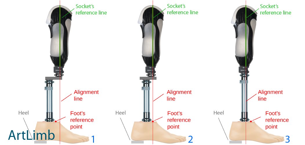 The alignment process of prosthesis consists of three elements: 
1-The Bench 
2-The Static 
3-The Dynamic