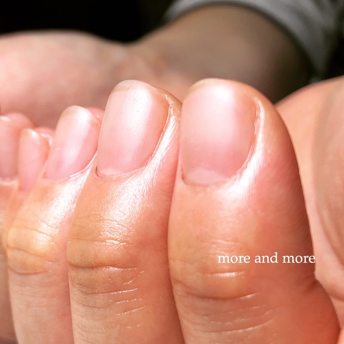 More And More ネイリスト Waka ﾟ Sur Twitter お客様ネイルです お仕事のストレスで爪 にも影響が出ていたお客様 現在は少し落ち着いています また黒い点からわかる指先の使い方が見えます 長くなるので続きはinstagramで T Co Jwvaxxpntz