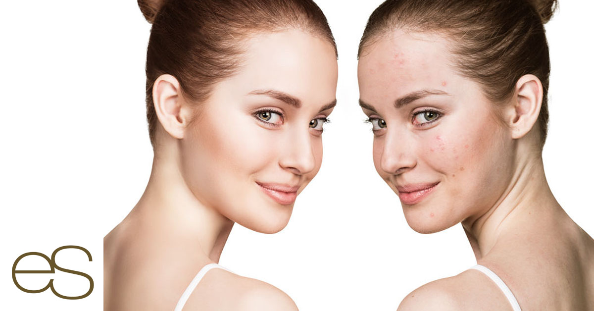 Es necesario preparar la piel antes de exponerla al sol. Una exfoliación previa ayuda a eliminar las pieles muertas y limpiar impurezas, lo mejor de cara al verano. Visita nuestro centro, te asesoramos.

elenasotillo.com/medicina-estet…

#SpaCorporal #BellezaenelAljarafe #Exfoliantes