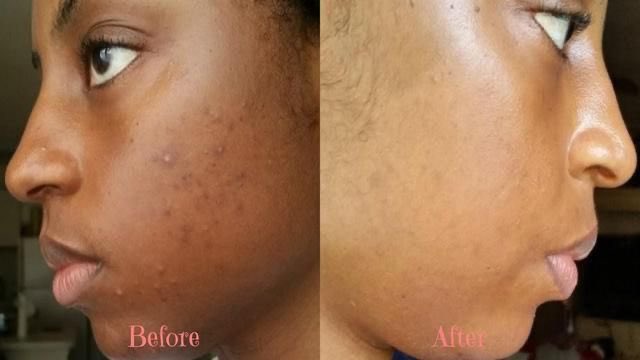 Hyperpigmentation is a common condition in which patches of skin become darker in color than the normal surrounding skin. This darkening occurs when an excess of melanin, the brown pigment that produces normal skin color, forms deposits in the skin.