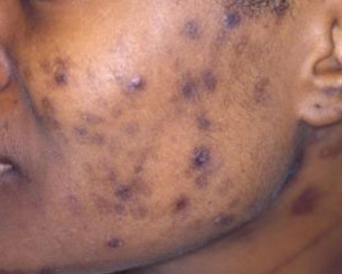 It’s commonly seen in conditions such as acne